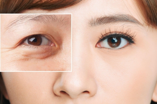 Top công nghệ trẻ hóa da vùng mắt được ưa chuộng 2026