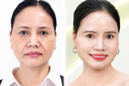 Nâng cơ trẻ hóa là gì? Công nghệ làm đẹp được nhiều người lựa chọn