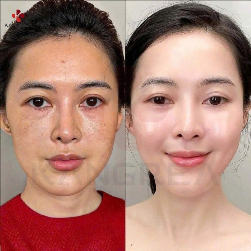 Trẻ hóa da mặt có tốt không? Sự thật bạn cần biết